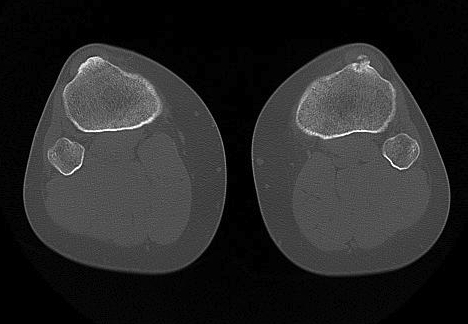 CT Axial Tibial Tuberosity